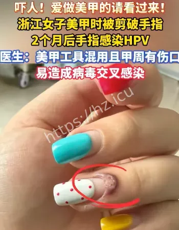 美甲感染HPV