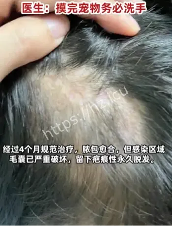 五岁女孩抱兔子患上脓癣