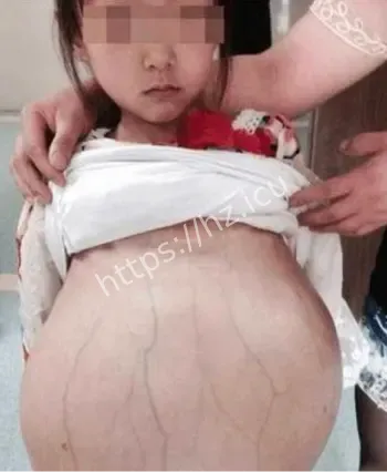 四川13岁女孩腹中3条蛇
